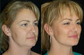 Buccal Fat Removal New York, NY, Plastic Surgery NYC